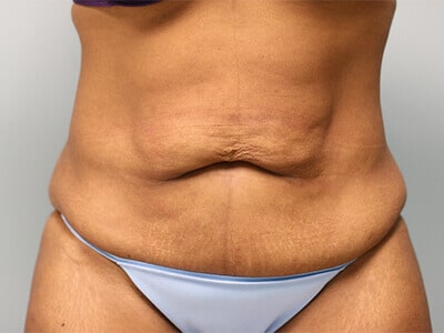 Tummy Tuck Scars Before & After, Patient 04