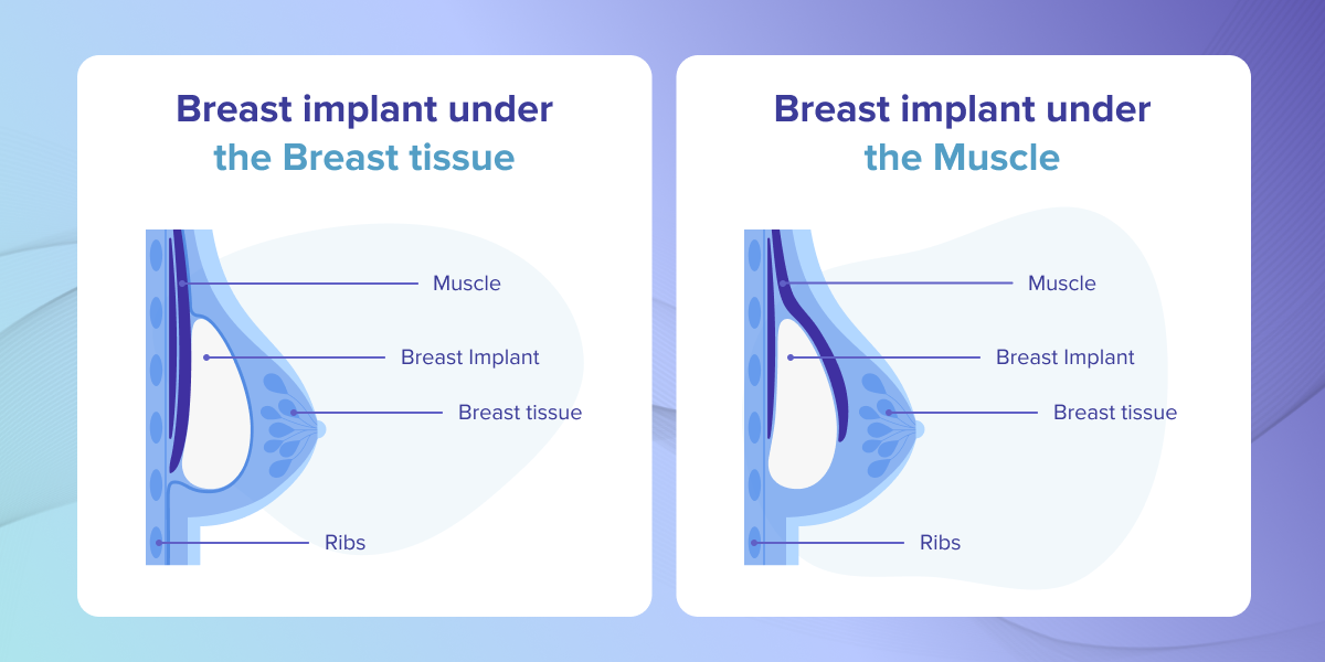 Diagram on implants over vs under muscle